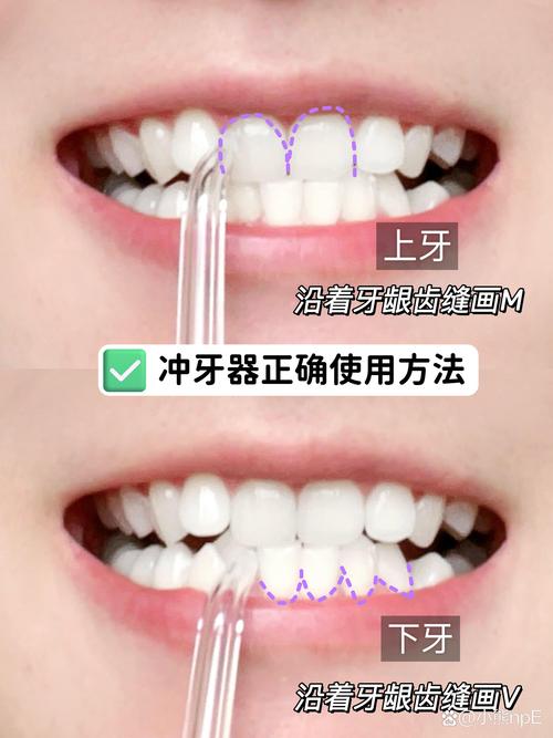 【产品参数冲牙器冲牙器怎么用巴氏刷牙法 牙线与冲牙器刷牙的牙齿